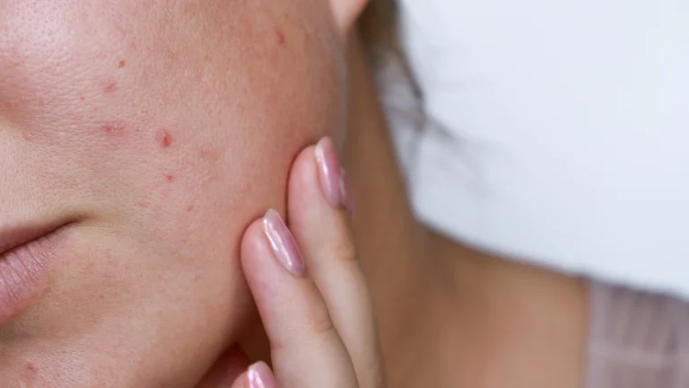 Skin purging - what is it?